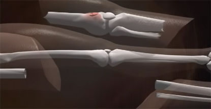 腿骨医学图，股骨、膝关节和胫骨上段被切除