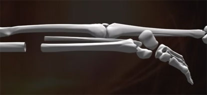 下腿骨与大腿骨连接的医学图示