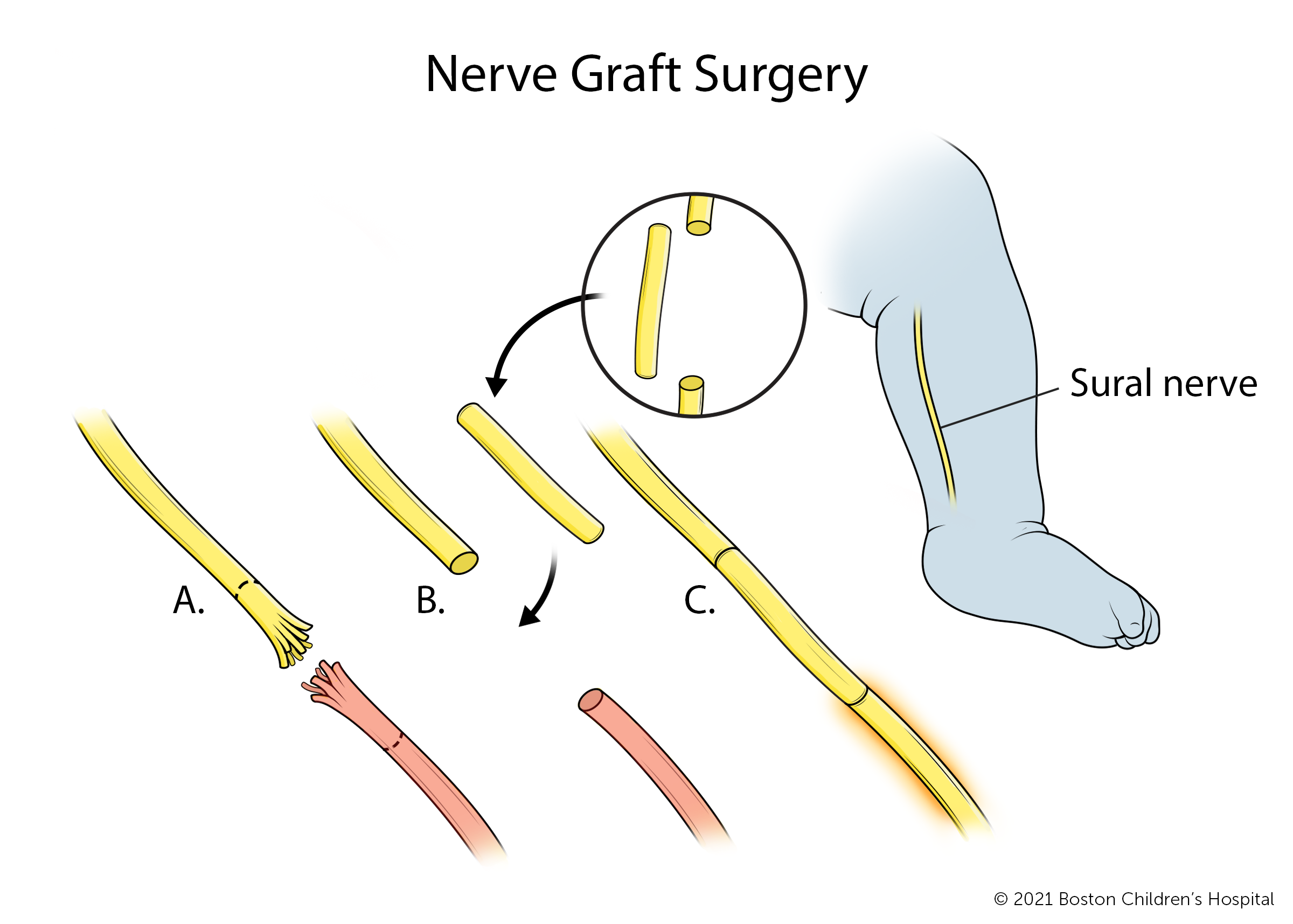 在神经移植手术中，受伤的部分臂丛神经被切除，并用来自腿部的腓肠神经代替。