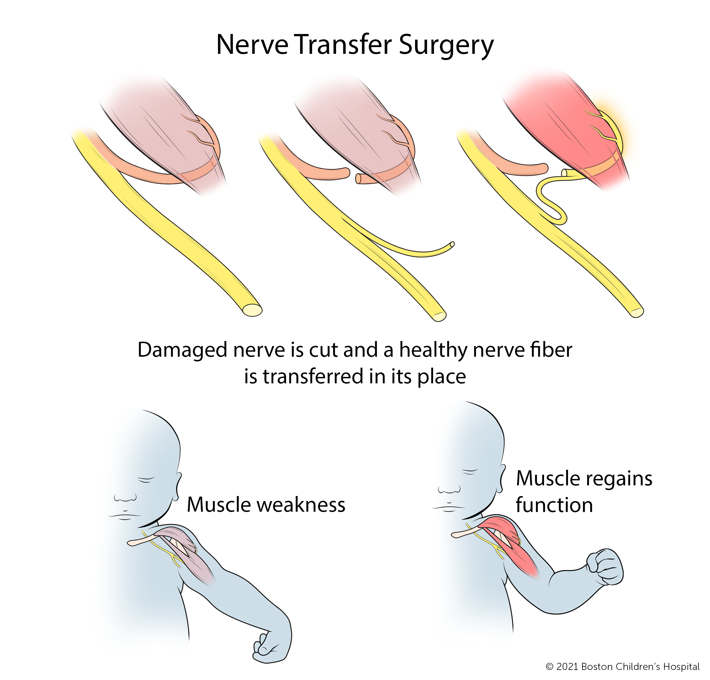 在神经移植手术中，受损的神经被切断，健康的神经纤维被移植到它的位置。随着时间的推移，肌肉无力的区域会恢复功能。