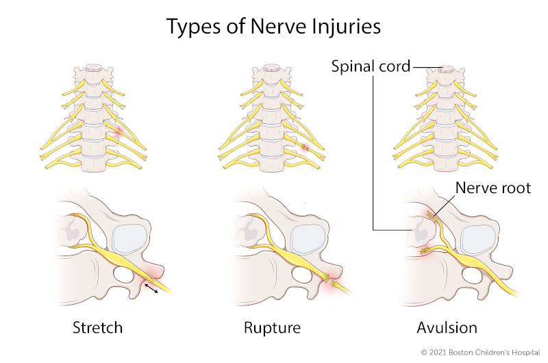 在伸展性臂丛神经损伤中，神经被拉伸，但没有撕裂。在臂丛神经断裂损伤中，神经被撕裂，但仍与脊髓相连。在臂丛神经撕脱损伤中，神经根与脊髓分离。