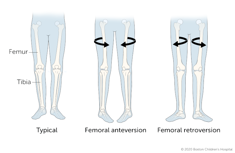 典型腿的图示，股骨前倾的腿和股骨后倾的腿。