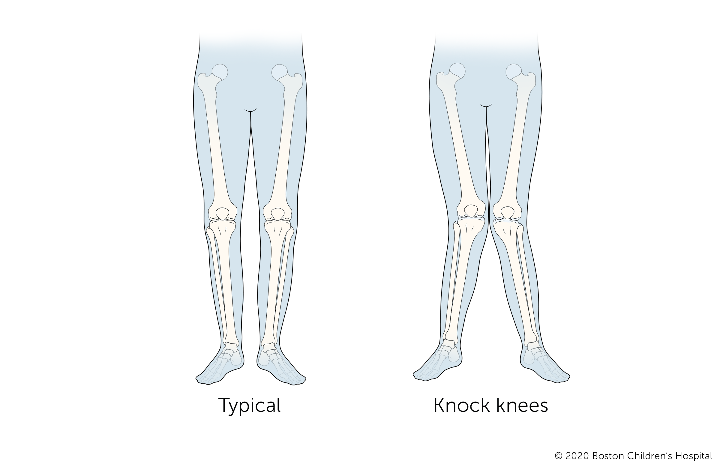 当孩子有双膝碰撞时，他们的膝盖向内倾斜，而脚踝保持分开。