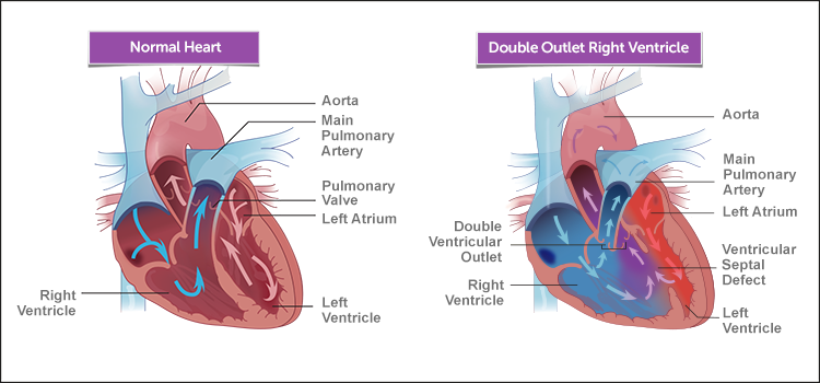 正常心脏和DORV心脏图示