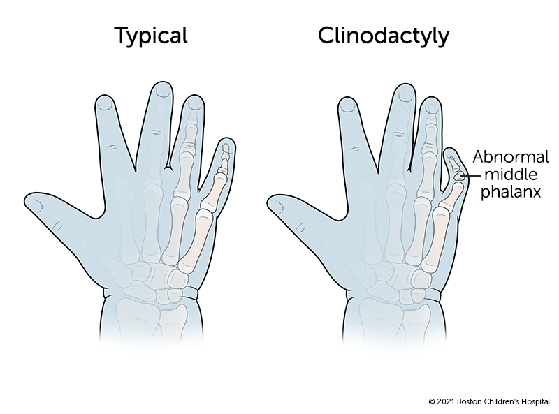 在有侧指畸形的手指中，中间的骨头(指骨)呈三角形，导致手指畸形地向一侧弯曲。