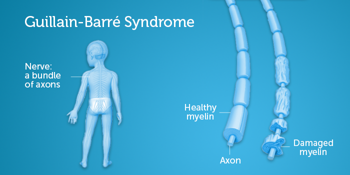 格林-巴利综合征:健康的髓鞘和受损的髓鞘。