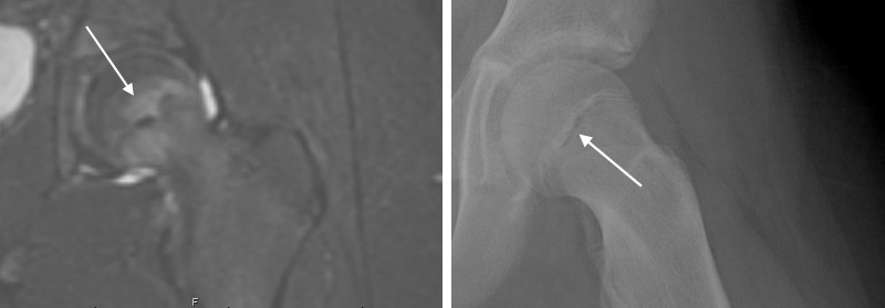图2:MRI(左)显示肾小管周围水肿，与肾小管周围透明的同一髋关节x线图像相比，提示SCFE
