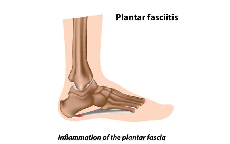 足底筋膜炎是痛苦在底部的一个或两个高跟鞋,造成足底筋膜发炎,致密组织乐队连接脚后跟到脚趾。