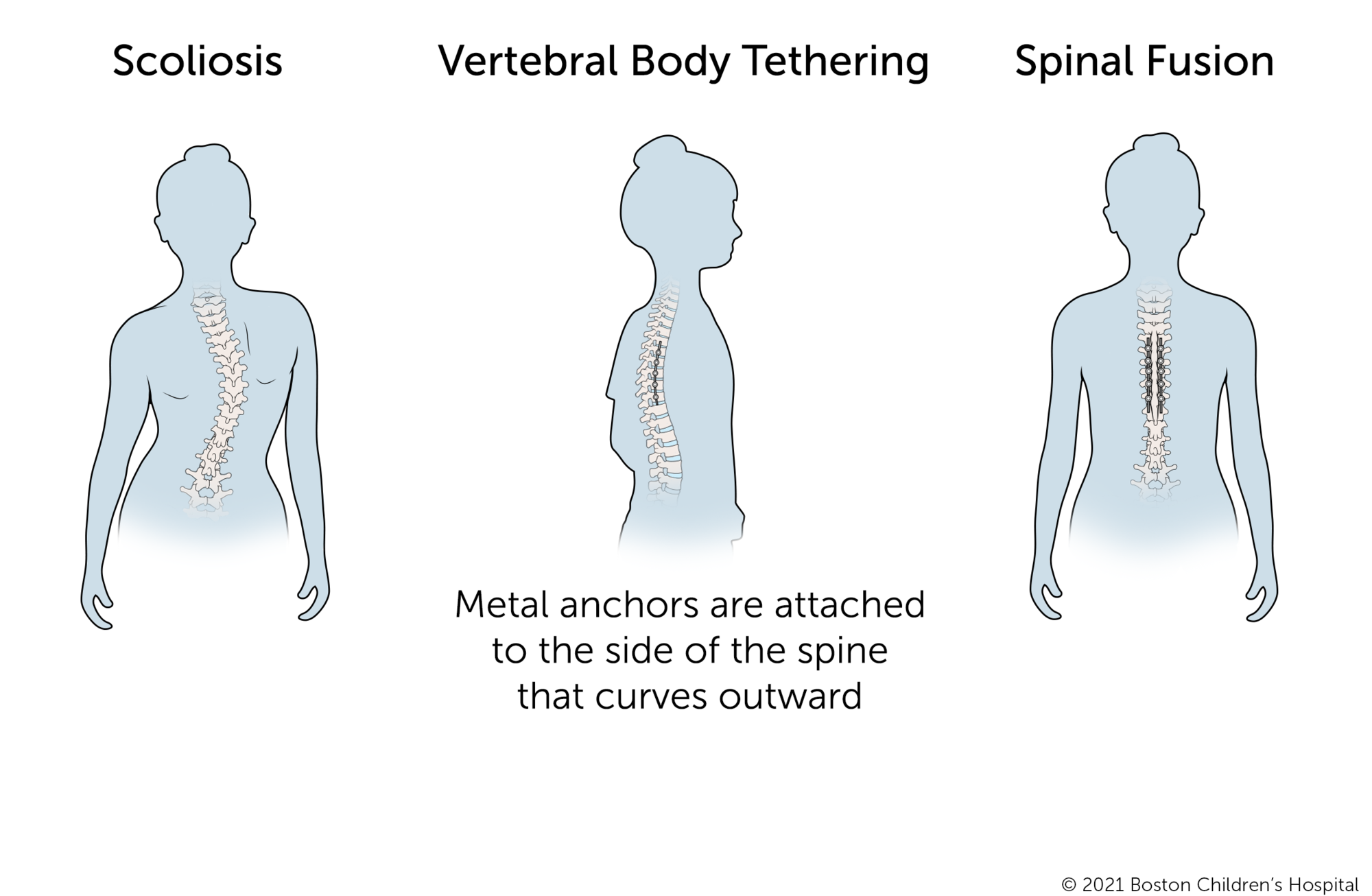 椎体拘束是一种新的程序轻度脊柱侧凸。金属锚和灵活的系绳相连的脊柱曲线向外。相比之下,对脊柱融合手术,金属锚和僵硬的棒连接到双方的脊柱。
