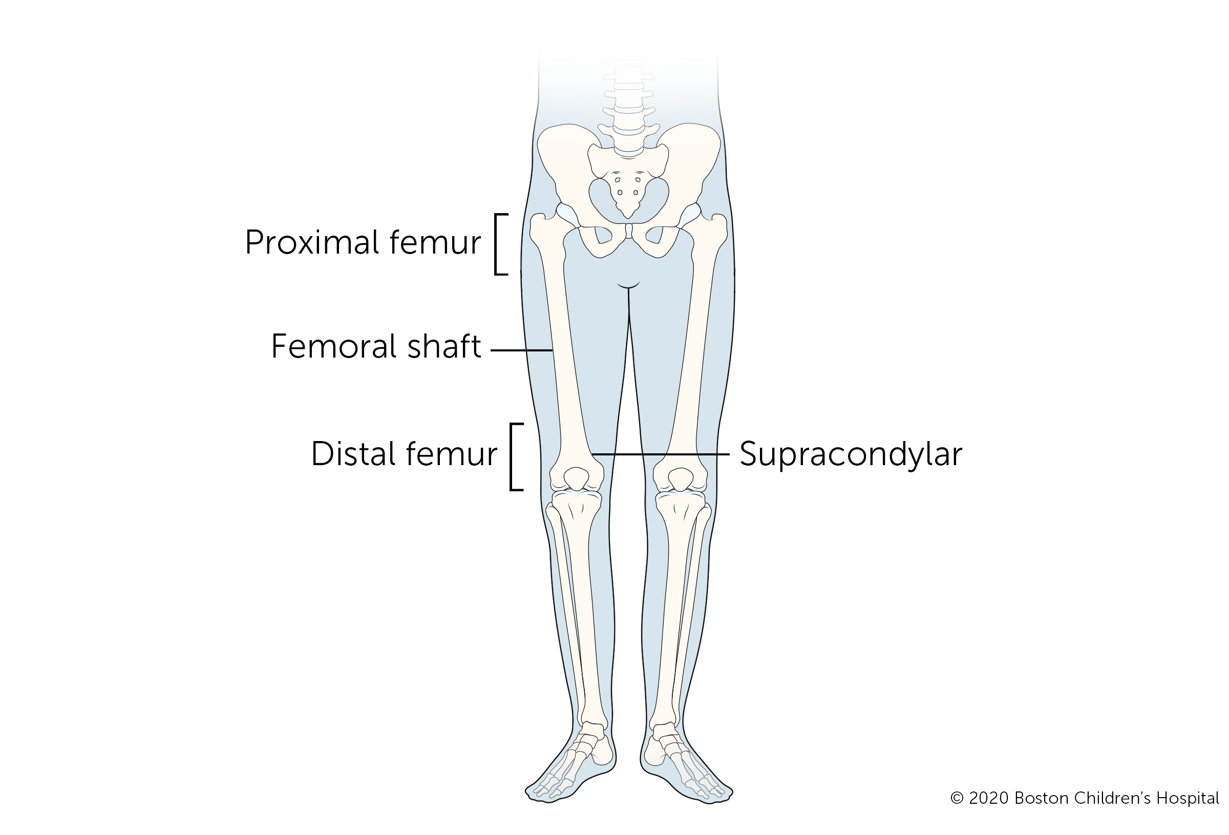 腿骨折的四种类型是股骨近端骨折、股骨骨干骨折、股骨髁上骨折和股骨远端骨折。