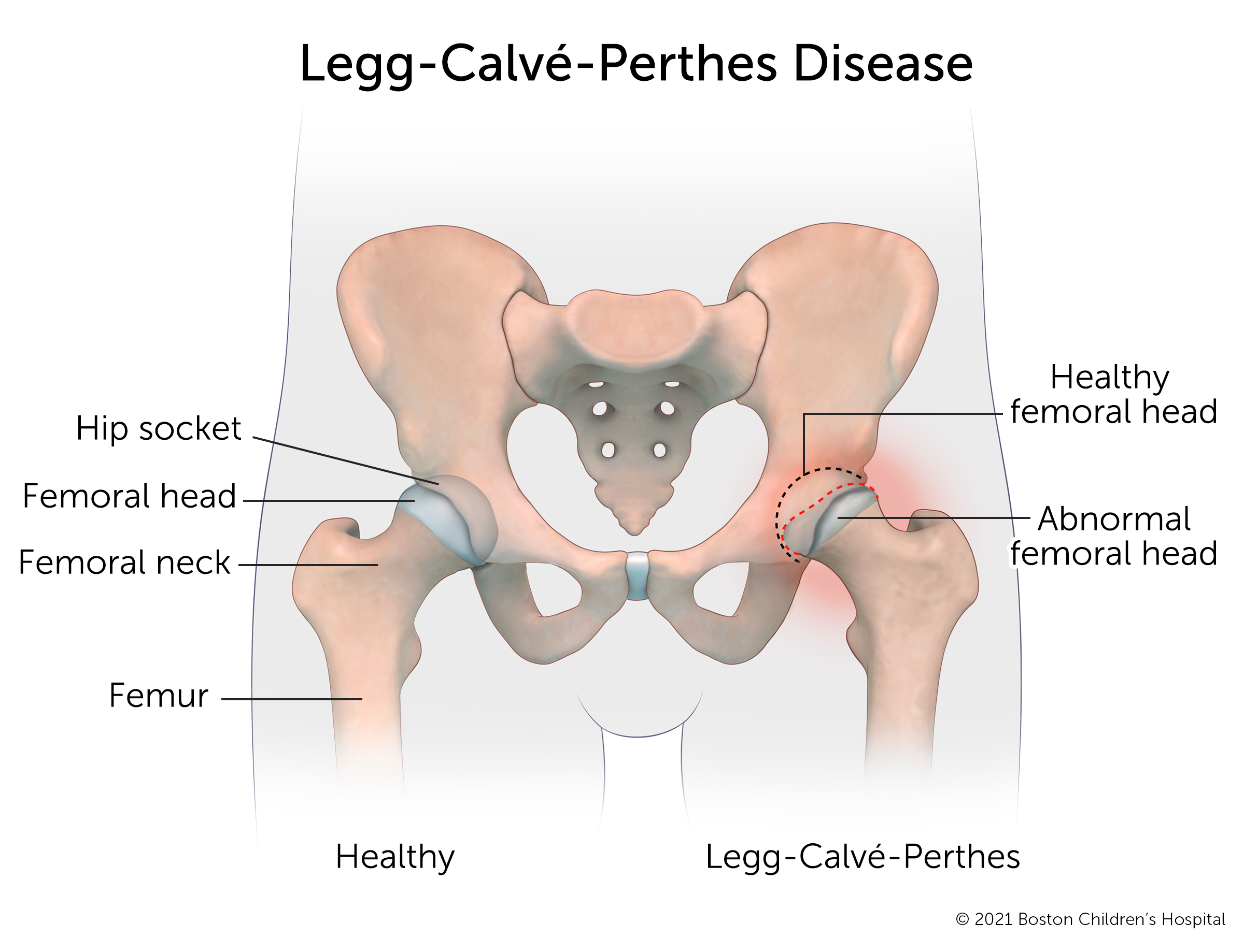 一个健康的髋关节与患有Legg-Calve-Perthes病的髋关节相比。在健康的髋关节中，股骨头是圆形的，可以安全地插入髋臼。在患有Perthes病的髋关节，股骨头变平了，在窝里有一个空的口袋。周围是红肿的。