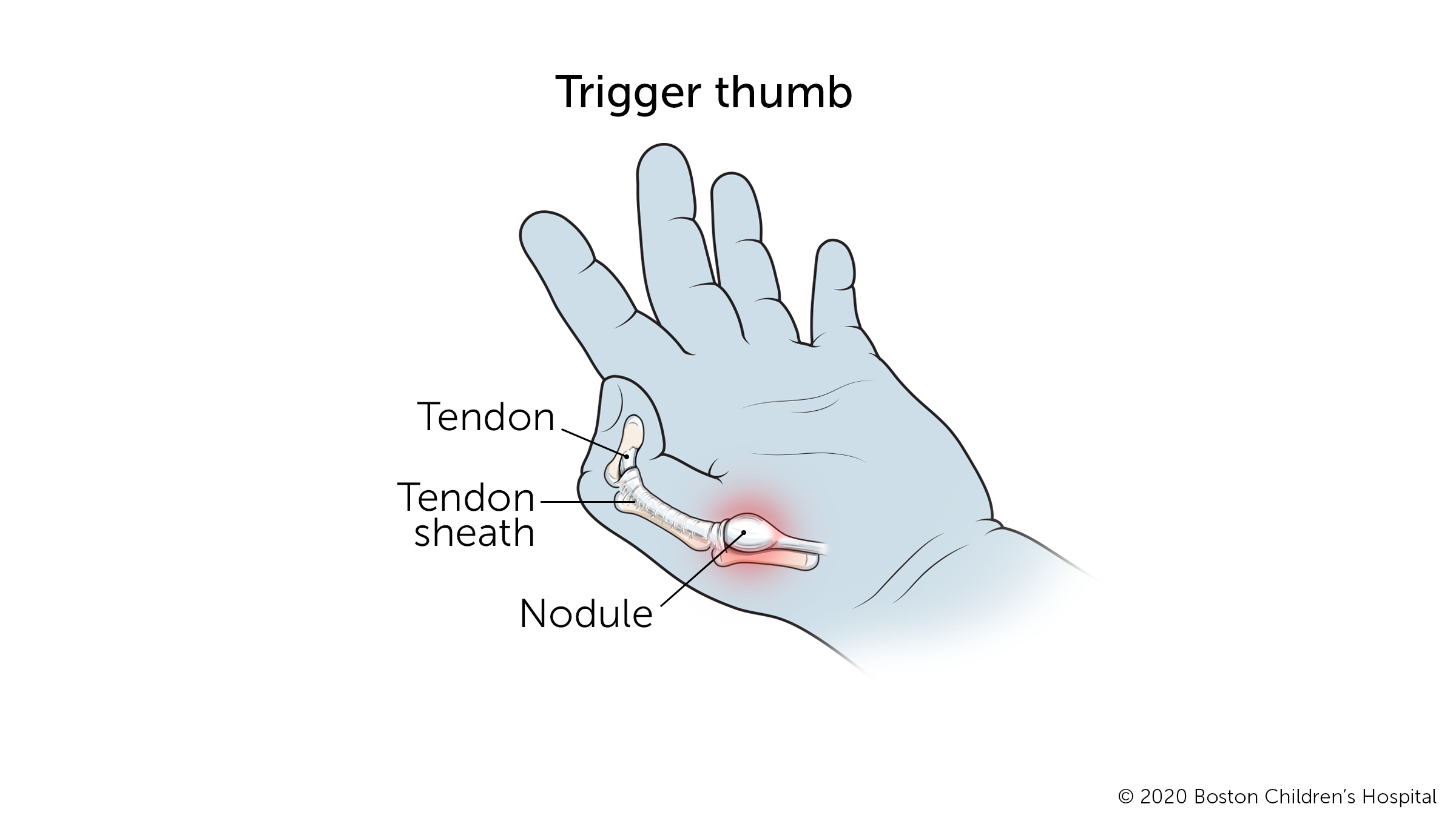 扳机拇指:当拇指底部的肌腱变得太大而无法在保护它的鞘内轻松移动时，就会在肌腱中形成结节。拇指变成弯曲的姿势。