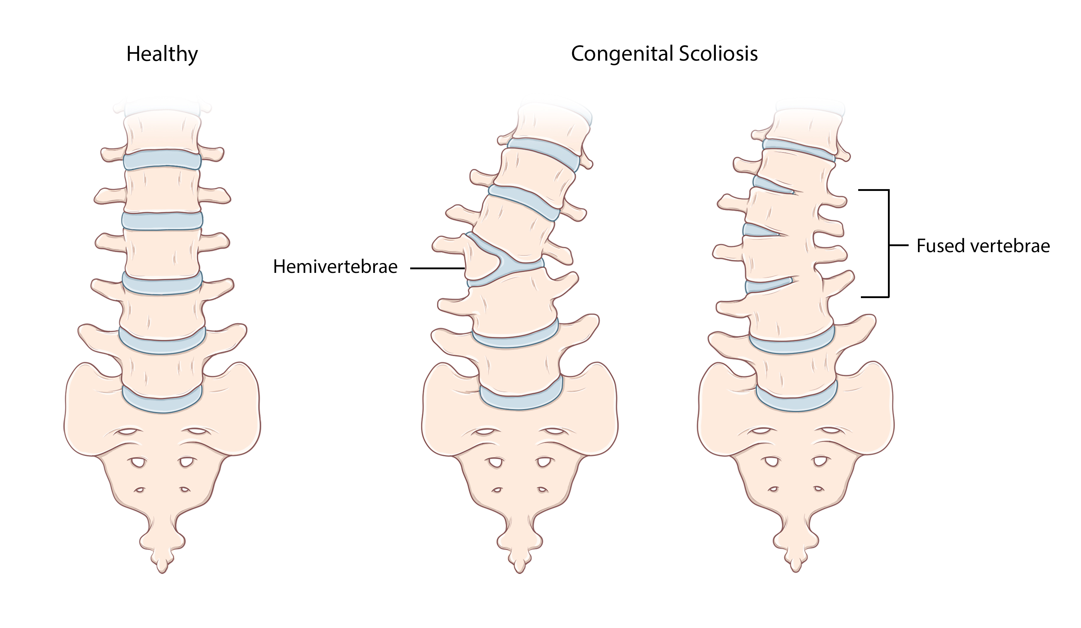 先天性脊柱侧凸发生在怀孕早期，脊柱中的一个或多个椎骨没有完全形成。