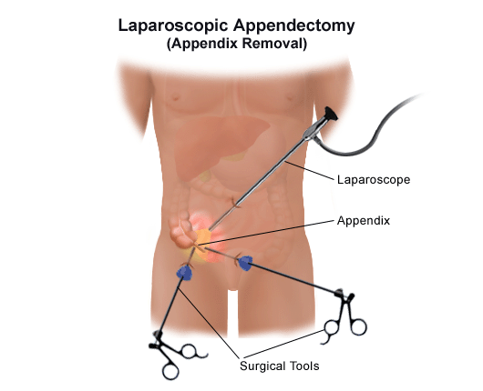 阑尾炎患者的腹腔镜阑尾切除术。