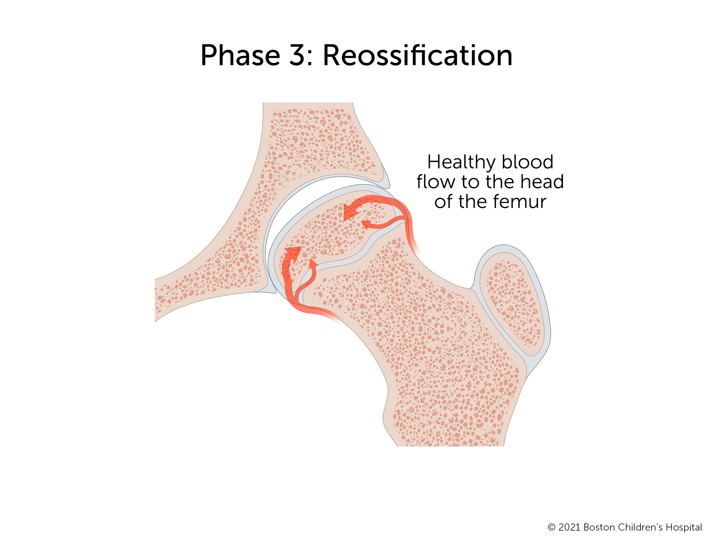 阶段3:Reossification。健康的血液回流到股骨头部，新骨生长，使窝内的空隙变小。