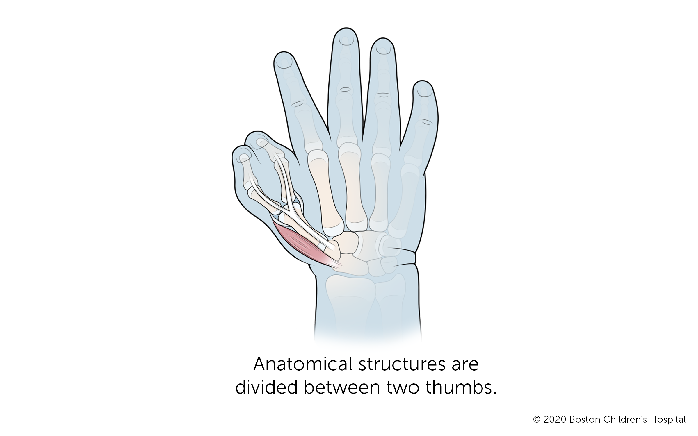 有两个拇指的手，其解剖结构被分为两个拇指拇指骨在拇指关节处分叉成两块由皮肤相连的骨头。
