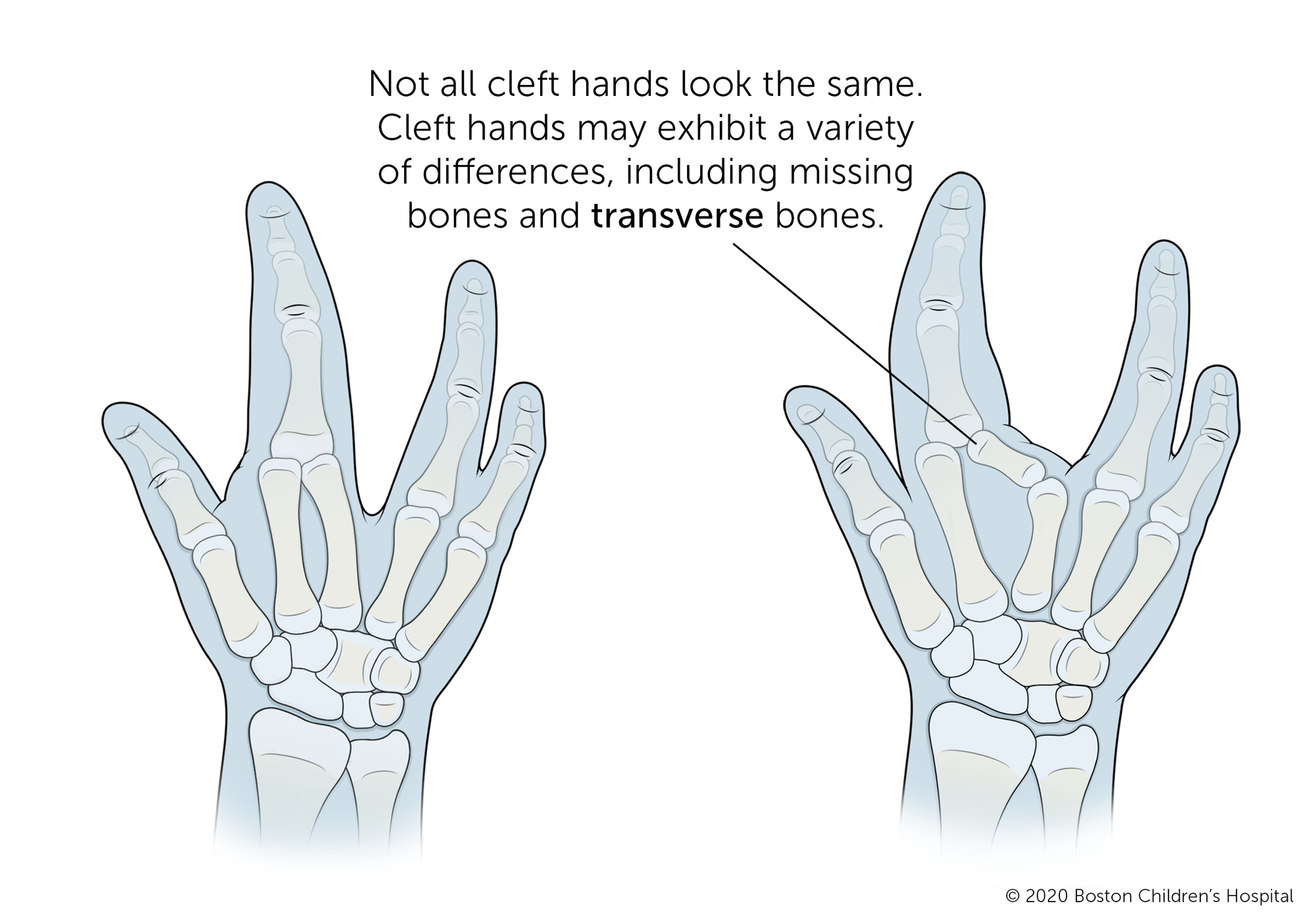 通常,裂手丢失了一个手指或手指中间的手,有一个明显的v型间隙空间。但不是所有裂手看起来一样。裂的手可能会出现各种各样的差异如失踪的骨头和横向的骨头。在某些情况下,裂缝发生拇指一侧或小指一侧的手。