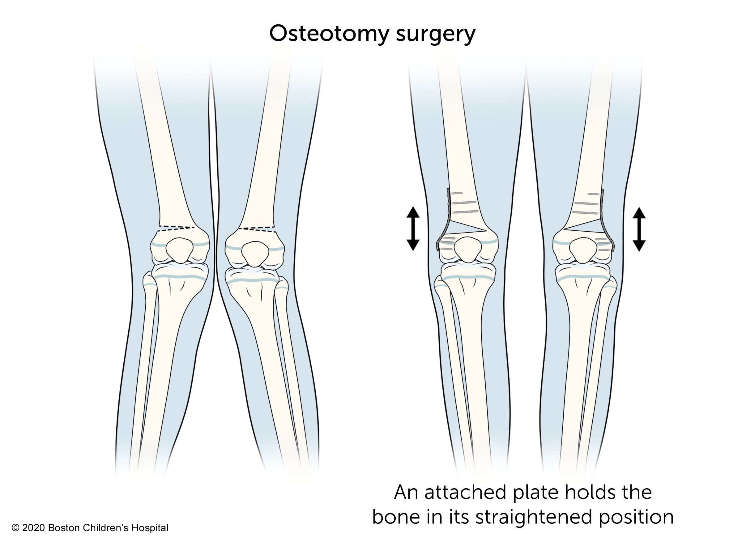 在截骨手术中，附着的钢板将骨头固定在其伸直的位置。
