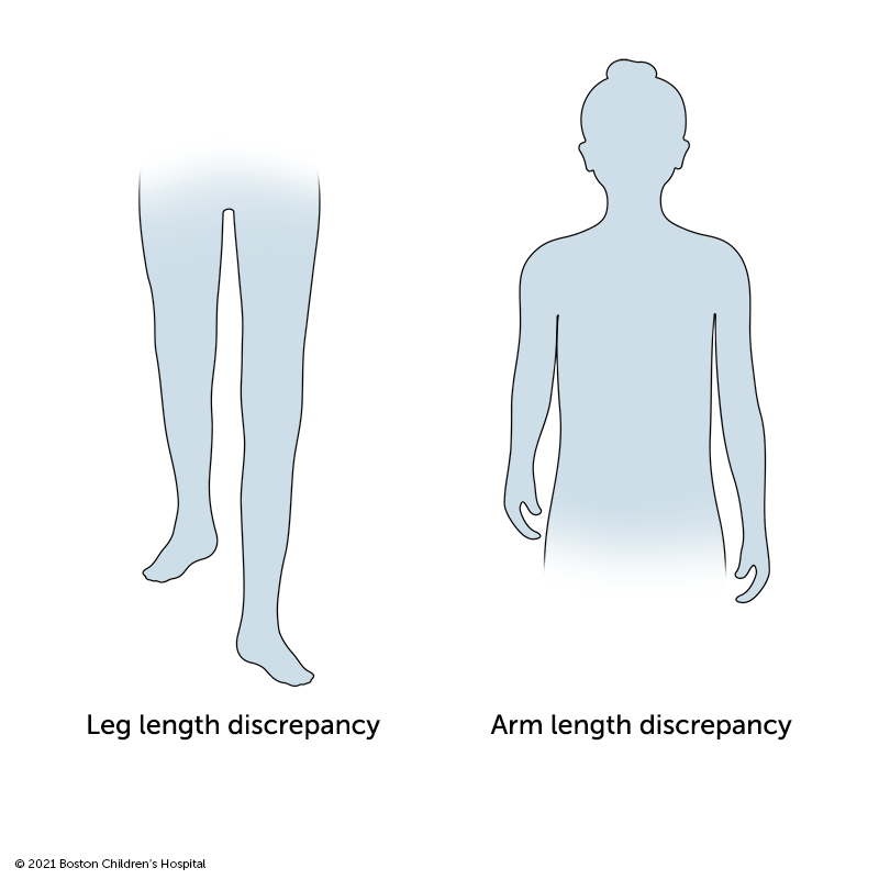 肢体长度差异|波士顿儿童医院- ob欧宝体育app下载