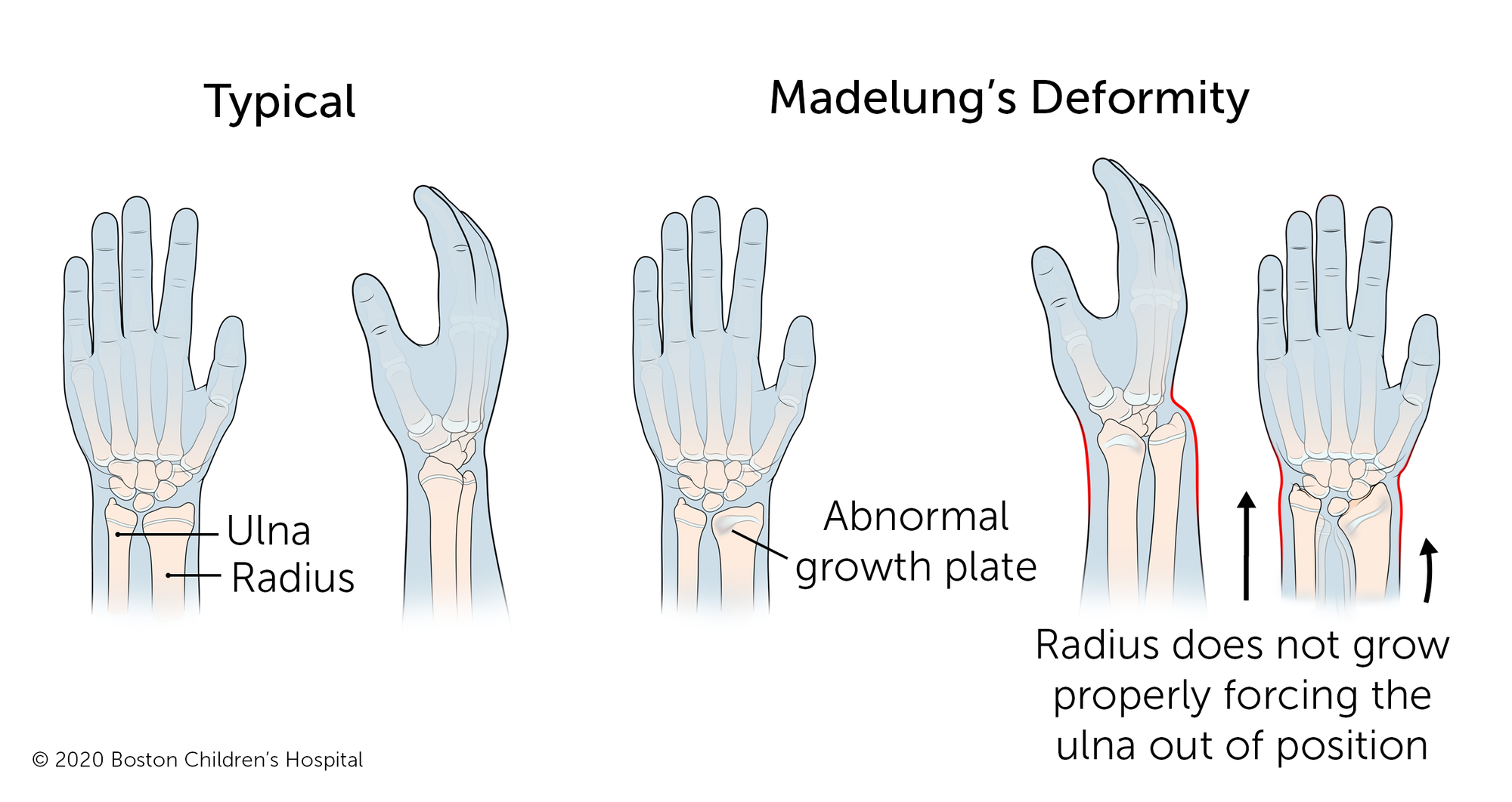在典型的手臂中，前臂的两个长骨（尺骨和半径）以光滑的线连接到手腕。随着Madelung的畸形，半径异常增长，迫使尺骨脱离位置。