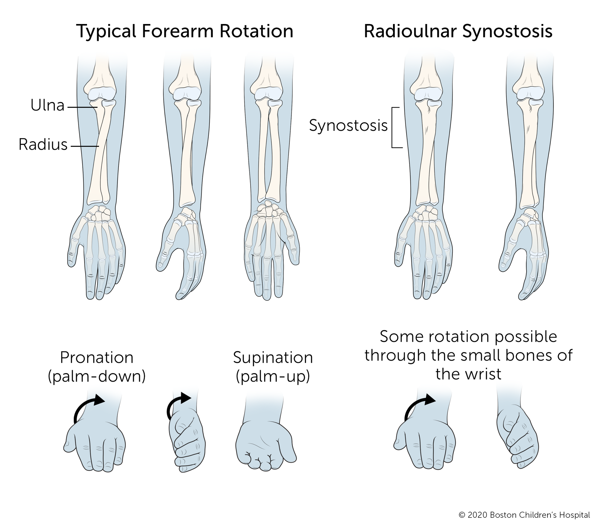 典型的前臂可以向两个方向旋转:手掌可以向下或向上。尺骨桡缝早闭，尺骨和桡骨连接，限制旋转。