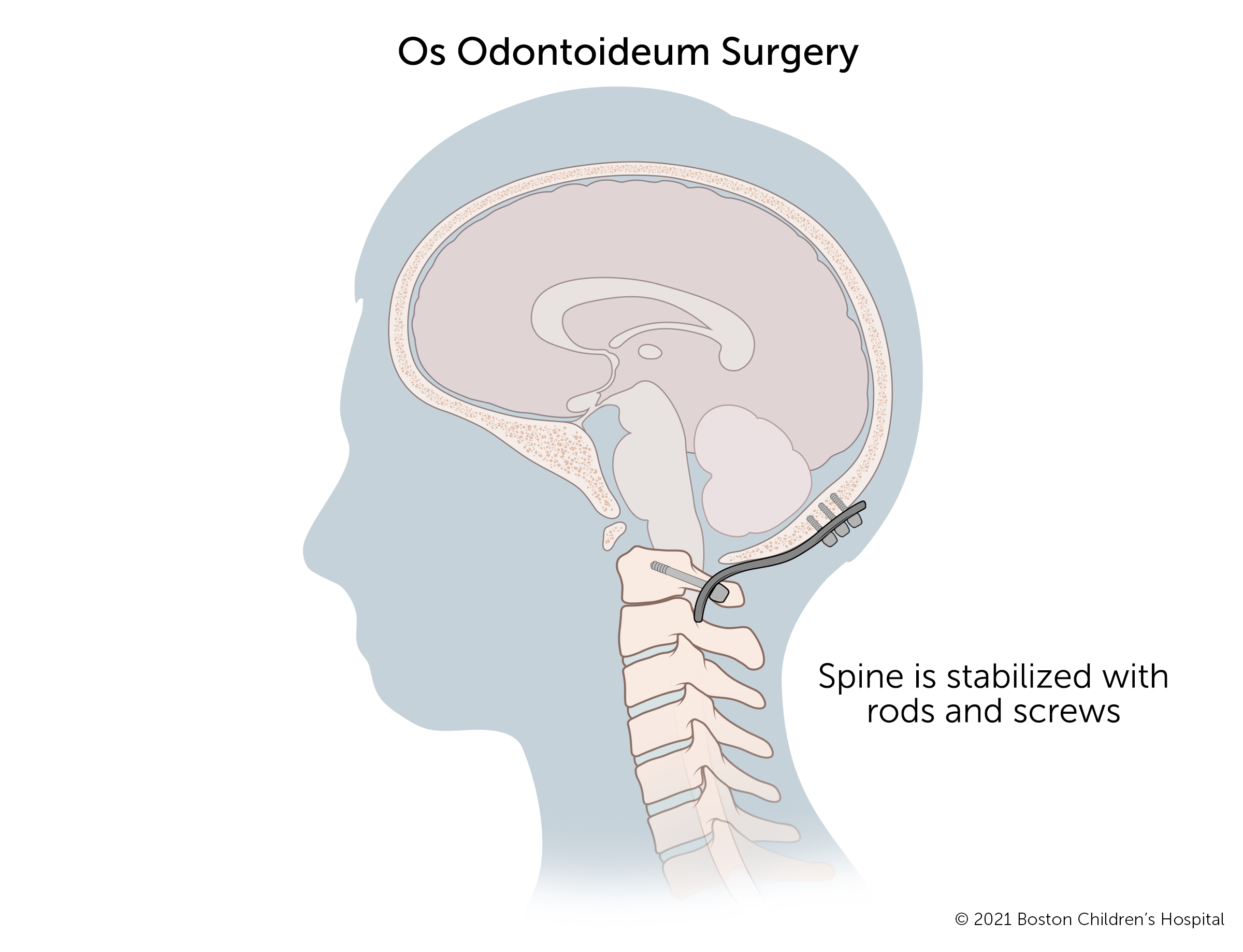齿状突手术包括调整颈椎椎体和减压脊髓。然后用杆和螺钉固定脊柱。