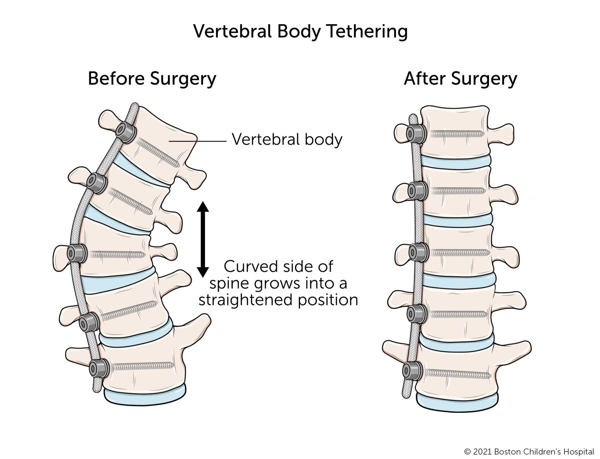 插图之前和之后的椎体拘束。在手术之前,有几个椎骨短比另一侧。侧弯矫形手术后附加的范围的脊柱,脊柱椎骨长成甚至形状和变得更直。