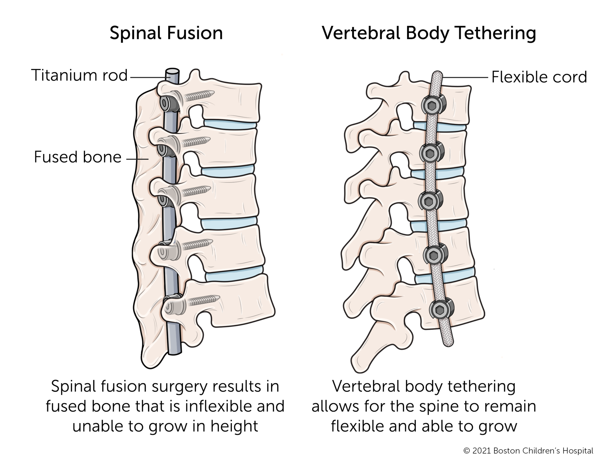 脊柱融合椎体相比拘束。脊柱融合手术导致融合骨不灵活,无法长高。脊柱椎体拘束允许保持灵活和能够成长。