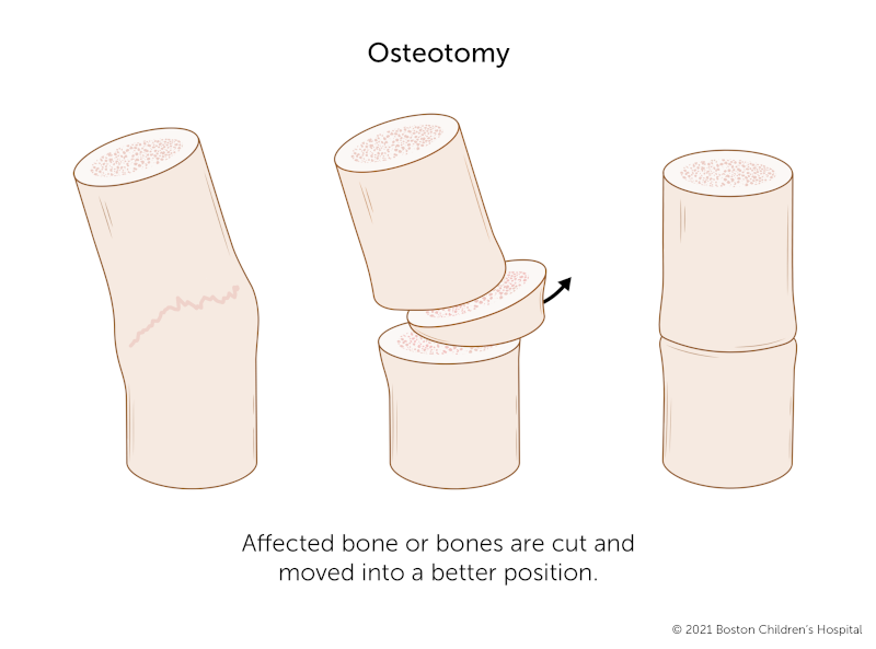在修复畸形愈合的截骨术中，骨头被切断并重新定位到更直的位置。