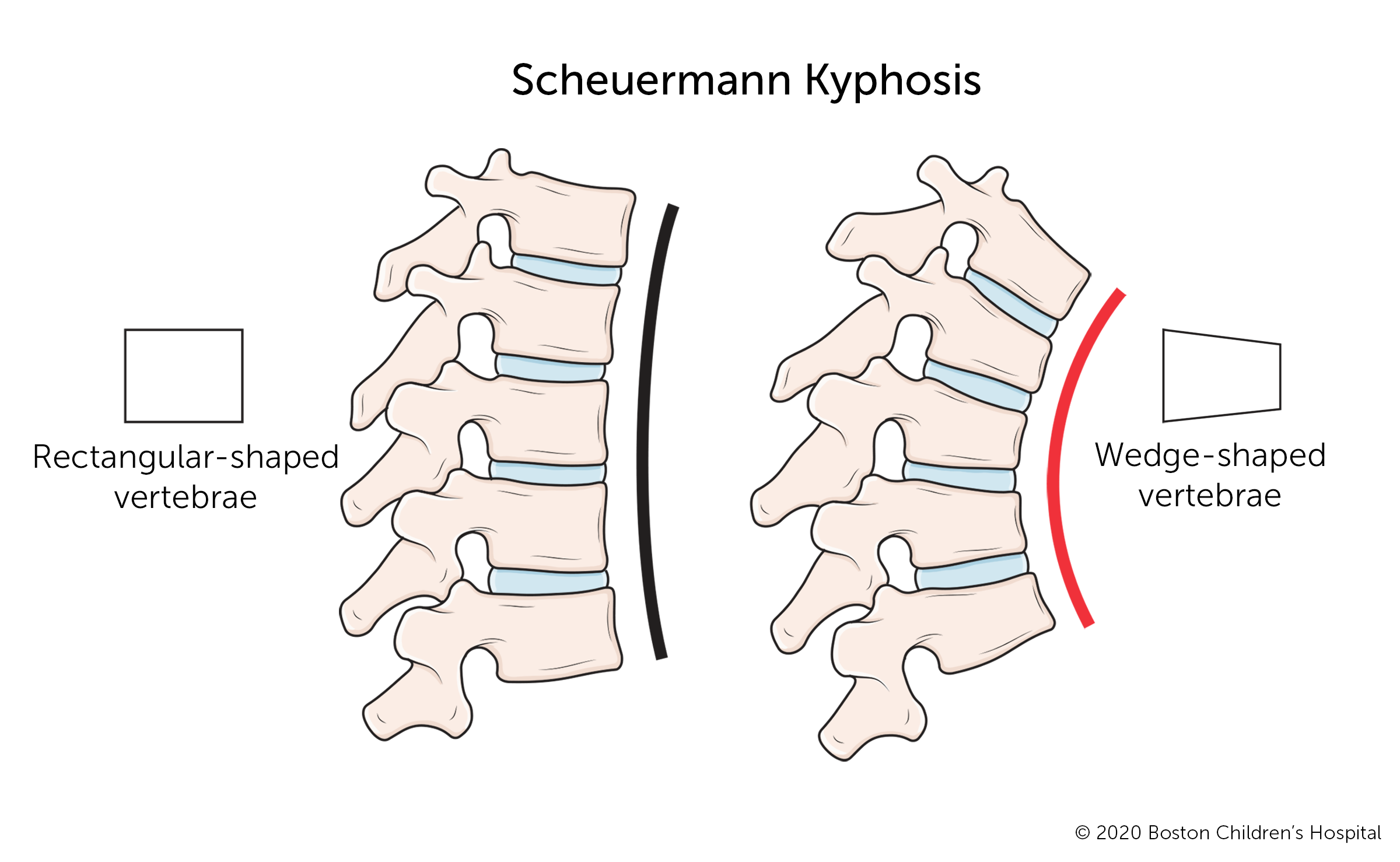 Scheuermann氏症，或称幼年后凸症，是一种结构异常，当胸椎的几个椎体发展成三角形(而不是矩形)形状时发生。