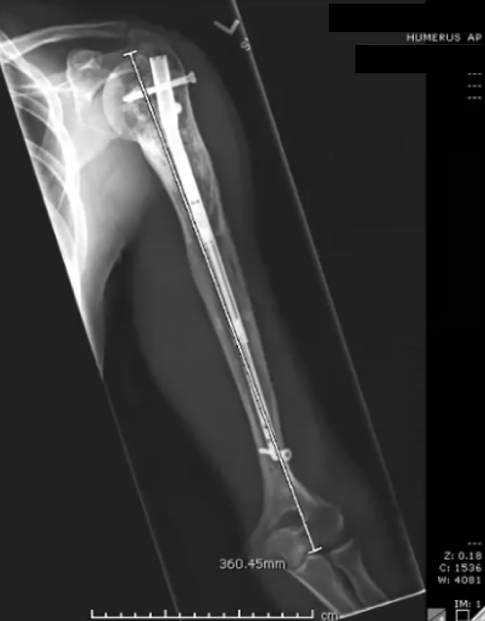 2021年1月拍摄的一张照片显示了再生骨在肱骨中的巩固位置。