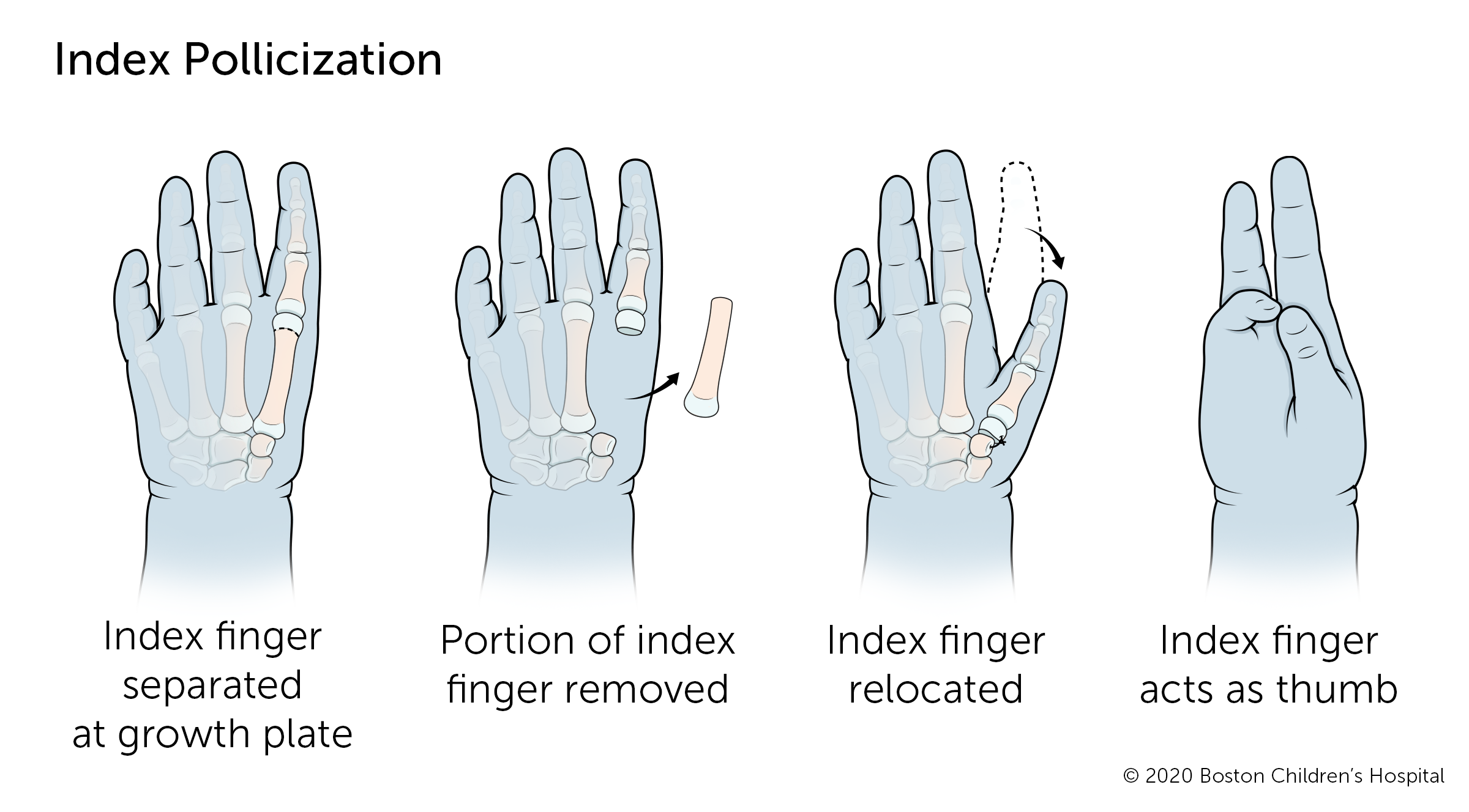 如果拇指完全失踪,指数pollicization手术将食指拇指的位置。食指在生长板分离,手指从手的一部分,剩下的手指重新安置,它可以作为一个经验法则。