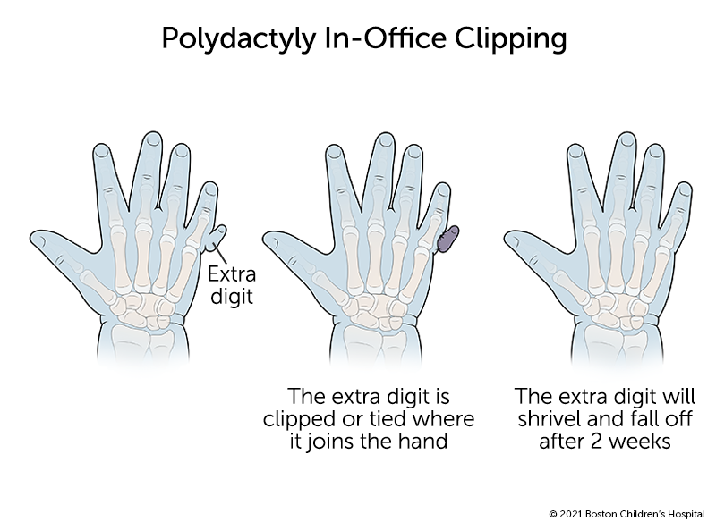 多指的手多了一个小指。在办公室夹手指时，多余的手指被夹住或绑在与手相连的地方。多余的手指会在两周后萎缩脱落。