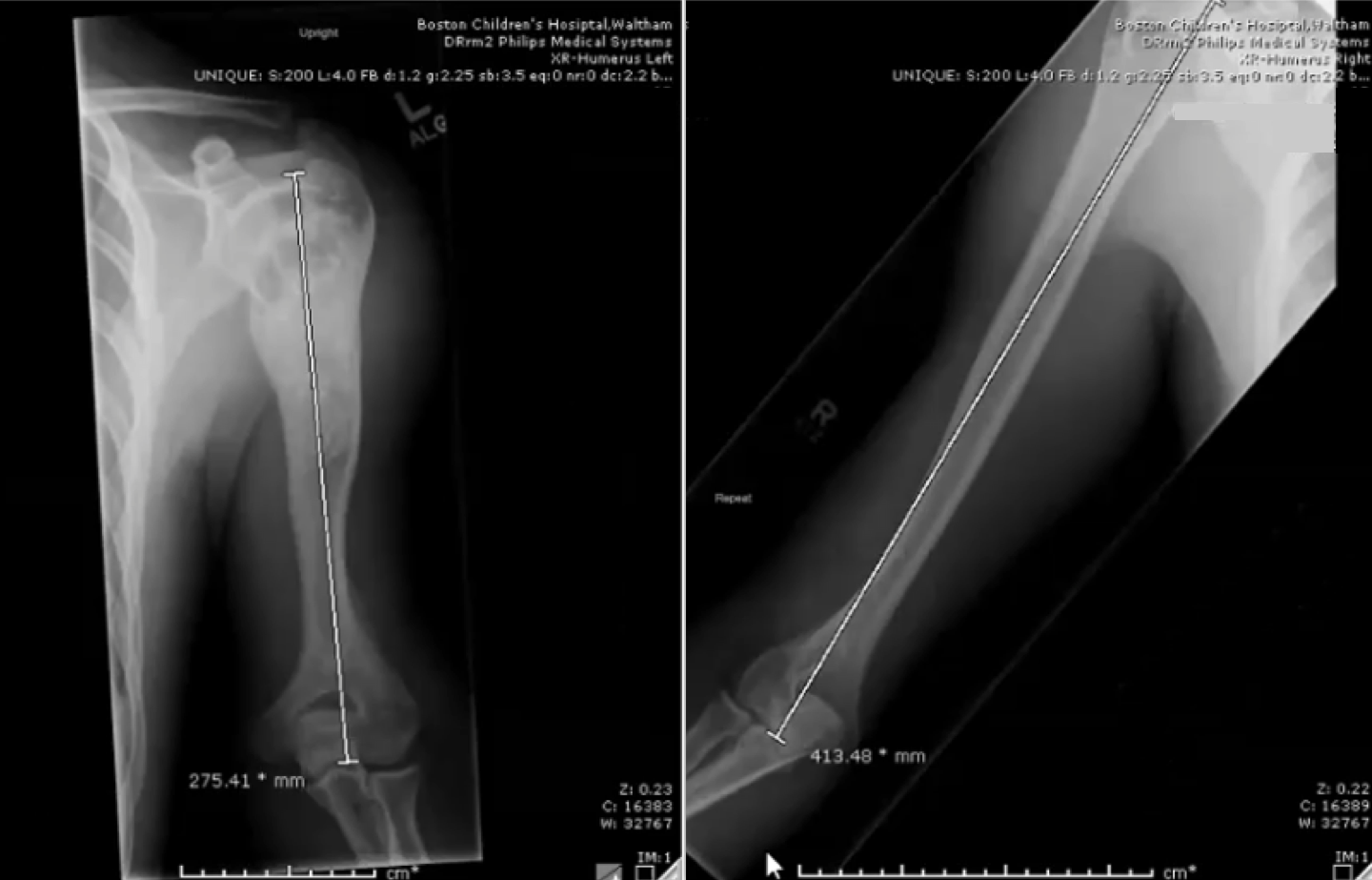 2019年2月，一名18岁患者的左(左)和右(右)手臂之间的长度相差138毫米。