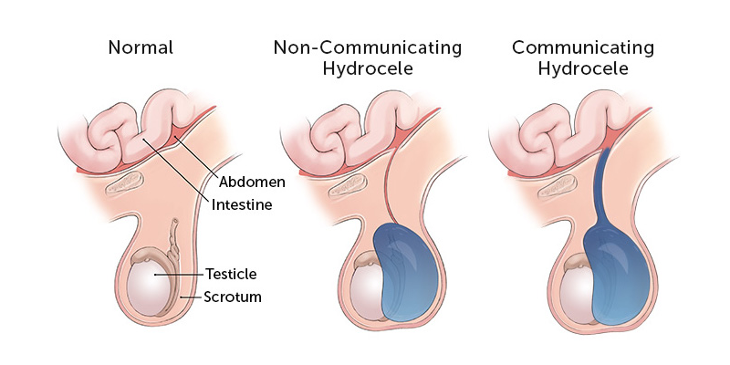 图示正常阴囊，一个为非交流性鞘膜积液，另一个为交流性鞘膜积液。