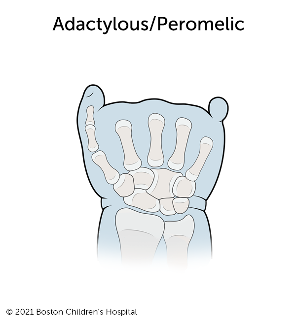 的形象adactylous / peromelic symbrachydactyly