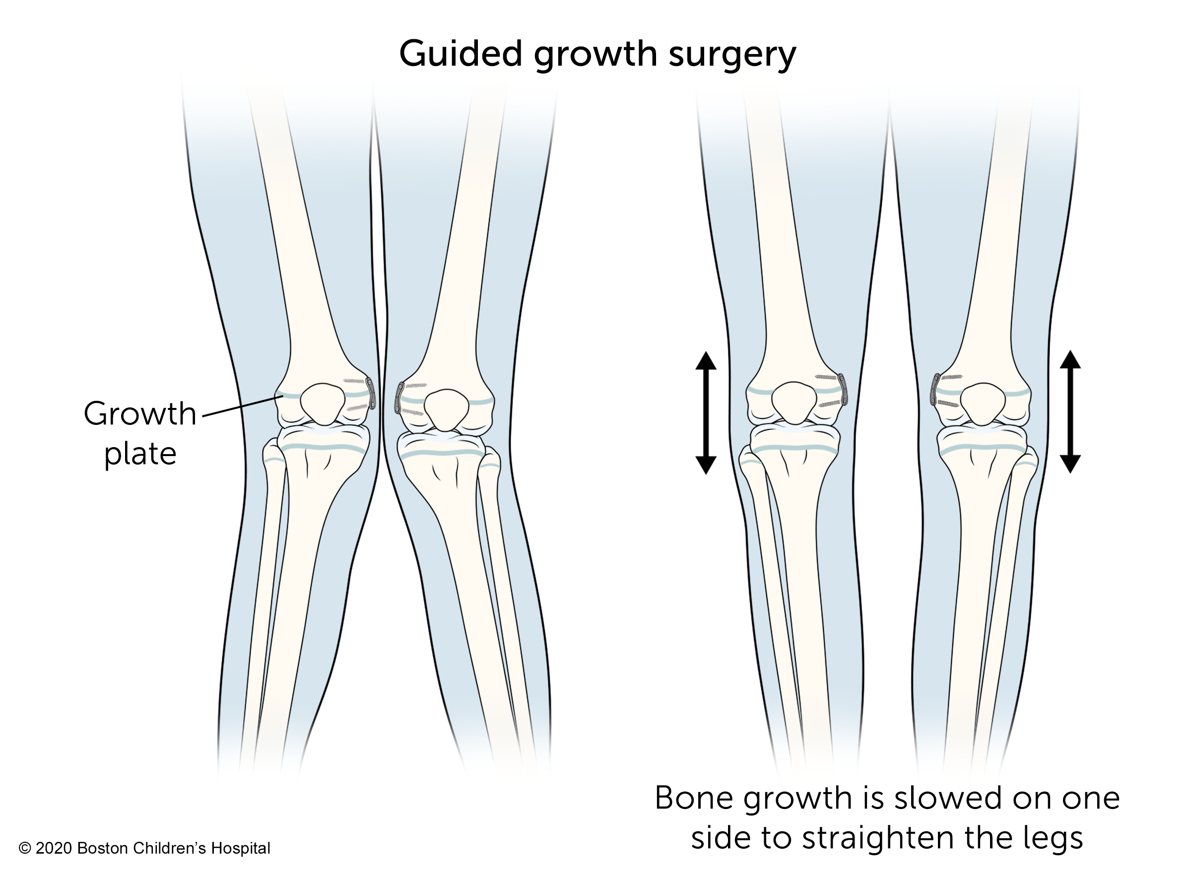 在引导生长手术中，一侧的骨骼生长被减慢以使腿部伸直。