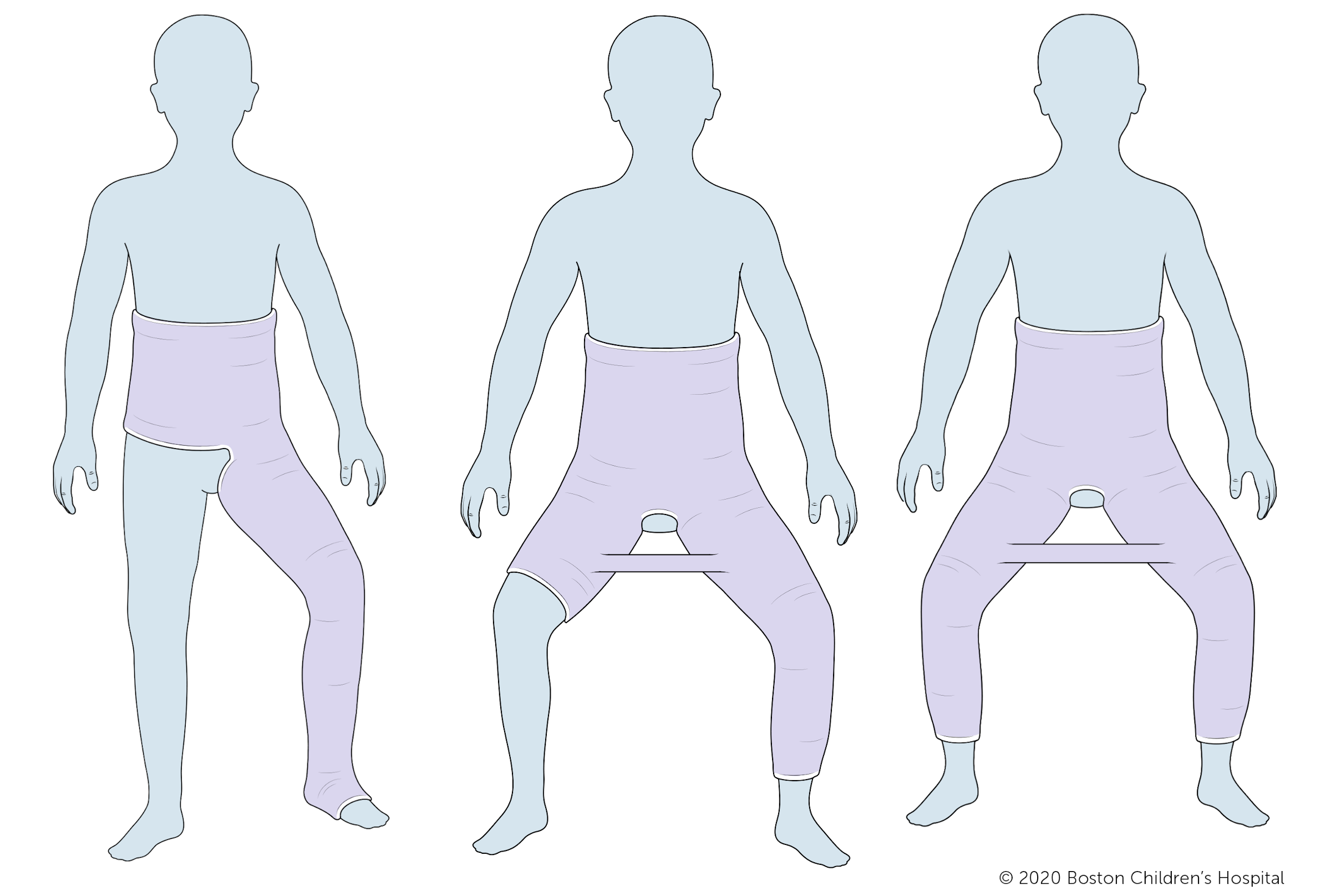 三种类型的石膏，从左起:单侧髋关节石膏，一个半髋关节石膏，双侧长腿髋关节石膏。