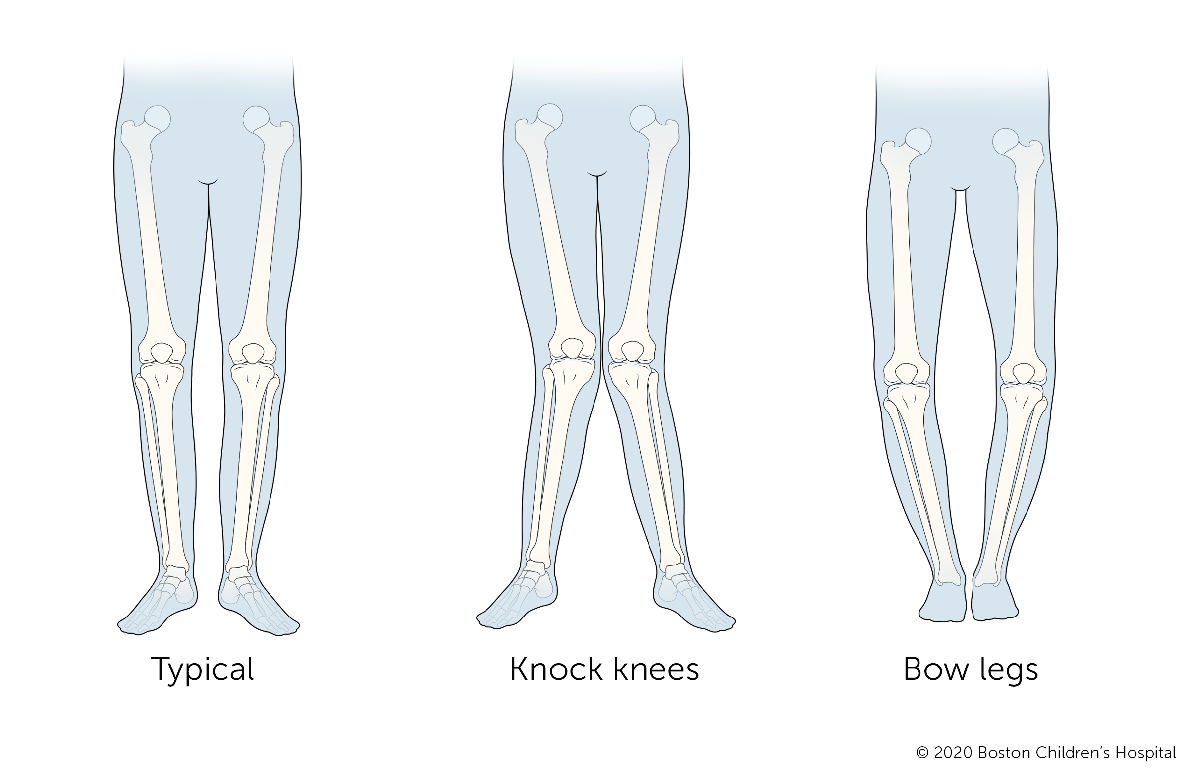 典型的腿的插图，腿与敲击膝盖，腿与弓形腿。
