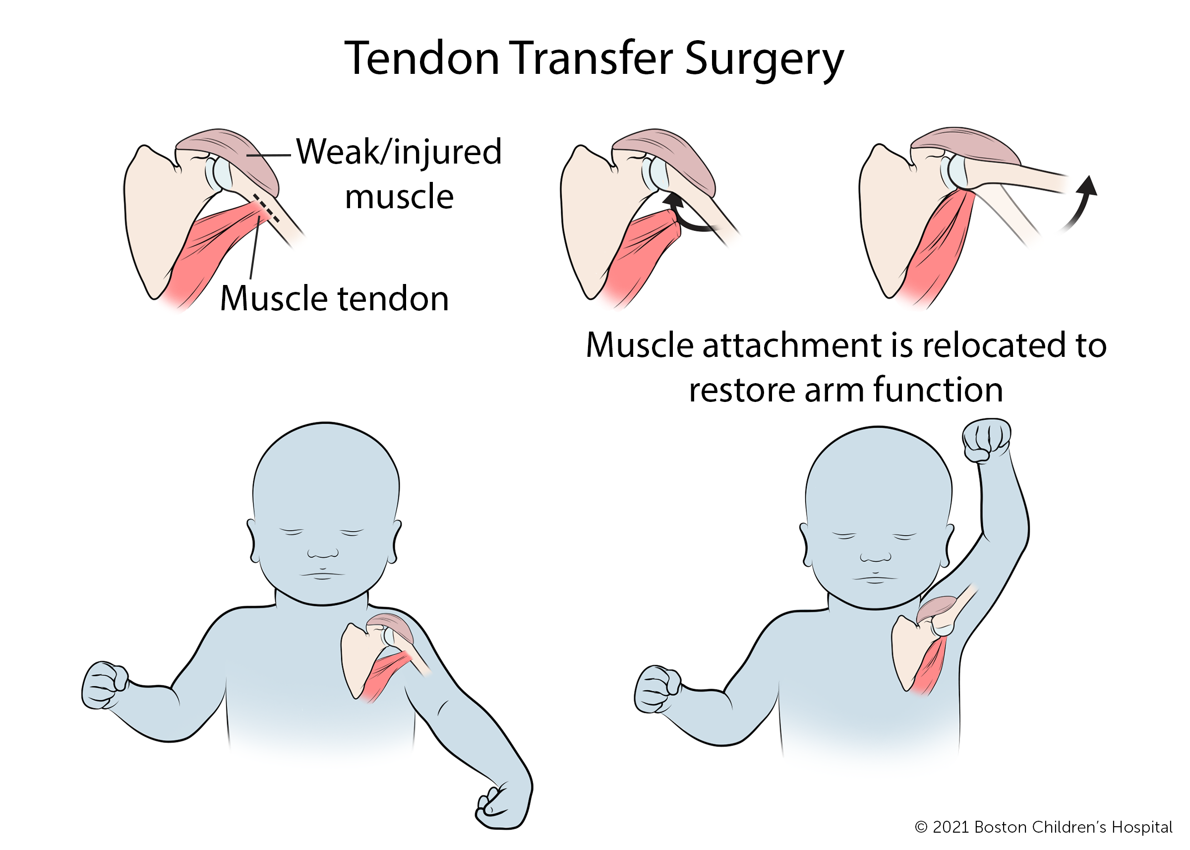 在肌腱转移手术中，将虚弱或受伤肌肉的肌腱从其正常附着点分离出来，并重新连接到一个新的位置，以恢复手臂功能。