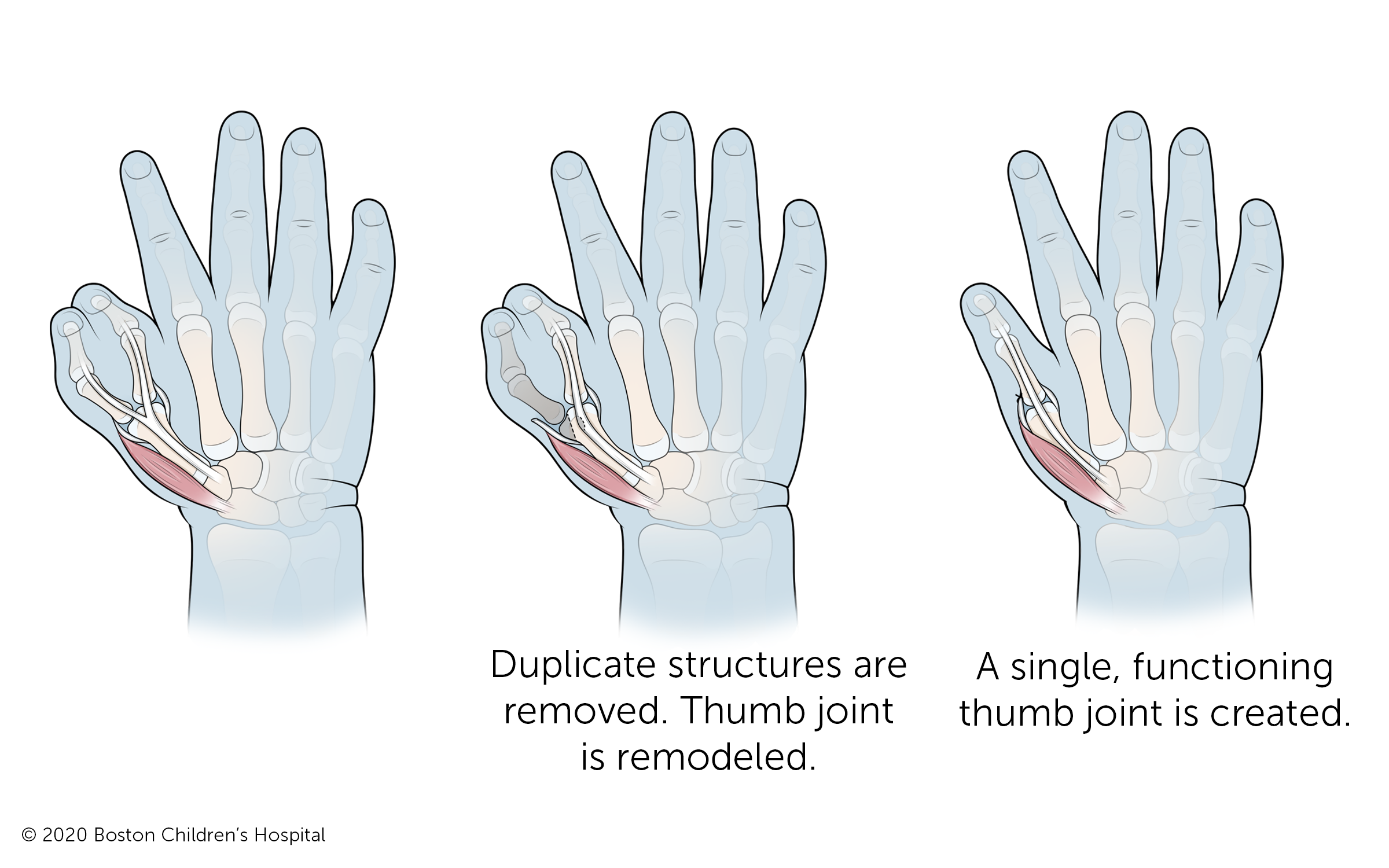 复制的骨头和其他结构被移除，之前两个骨头分叉的拇指关节被重塑，形成一个单独的、有功能的拇指和拇指关节。