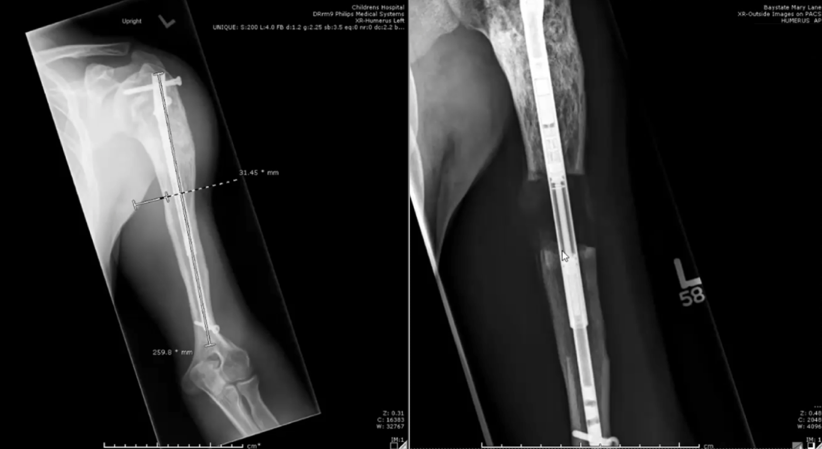 病人左臂延长两个阶段的x光片。第一种是通过手术将一根延长棒固定在上臂的骨头上。在第二种情况下，骨头已经被切断，在骨头末端之间有一个空间，棒子支撑着。在这个空间中可以看到新骨的生长。