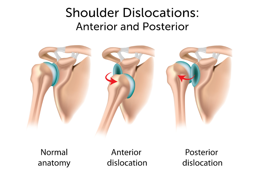 肩关节脱位可导致肱骨头移至肩关节盂的前面或后面。