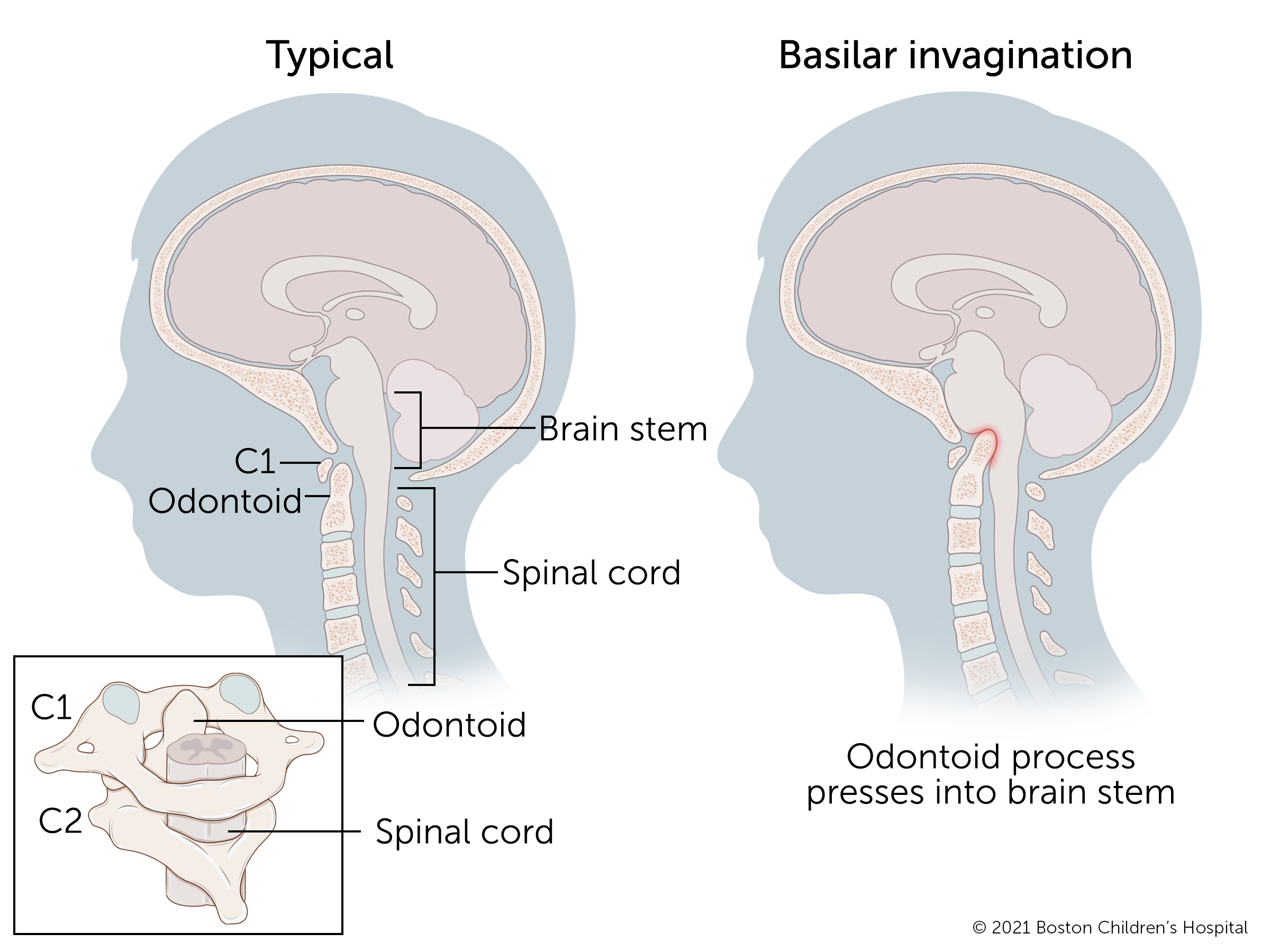 当一个孩子患有颅底内陷时，他们脊柱顶部的一个小洞会压入他们的脑干。