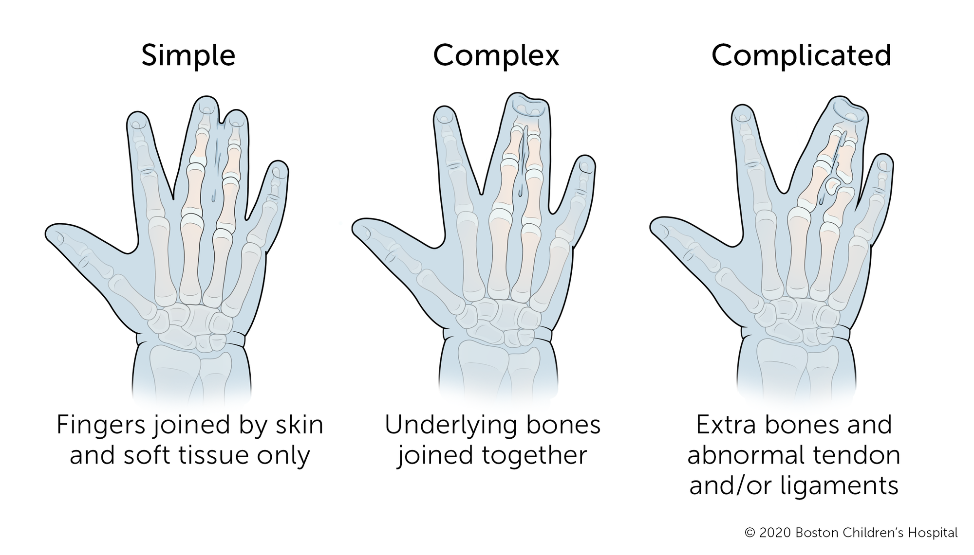 单纯并指指指间只有皮肤和软组织连接。复杂并指指下面的骨头也连在一起。复杂并指指有多余的骨骼和异常的肌腱和/或韧带发育。