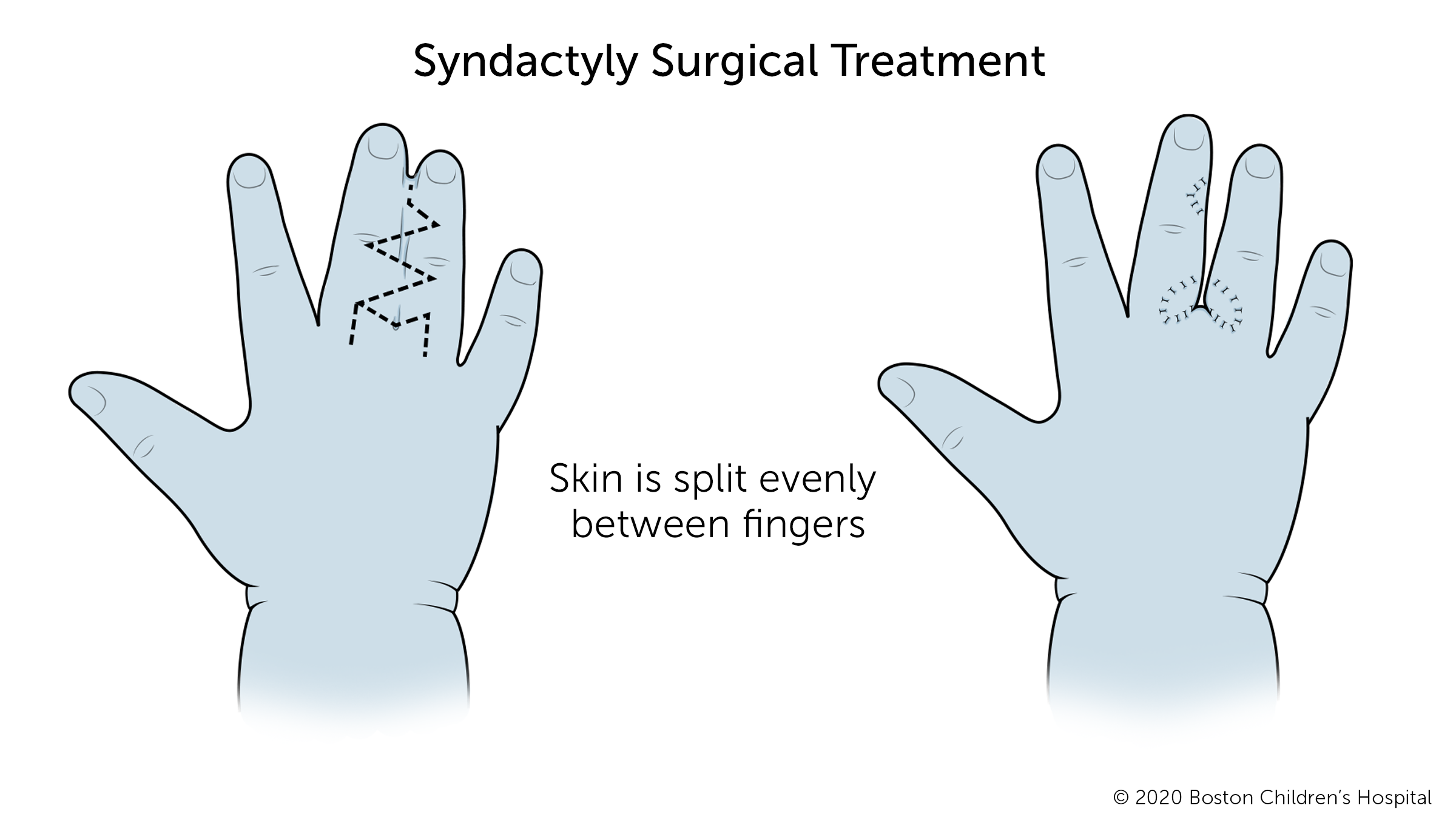 手术分离的连体手指的前后对比图。在手术中，手指之间的皮肤被均匀地分开。