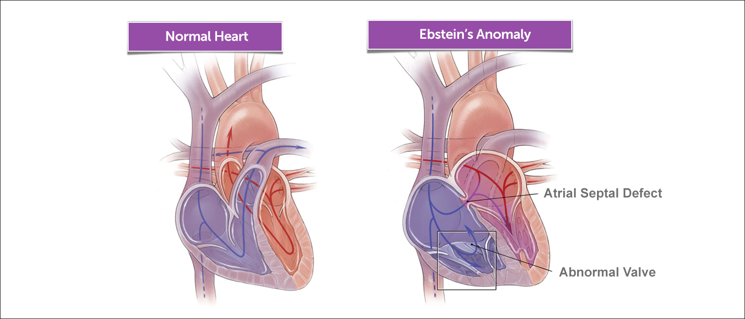 这是正常心脏和Ebstein异常心脏的图示