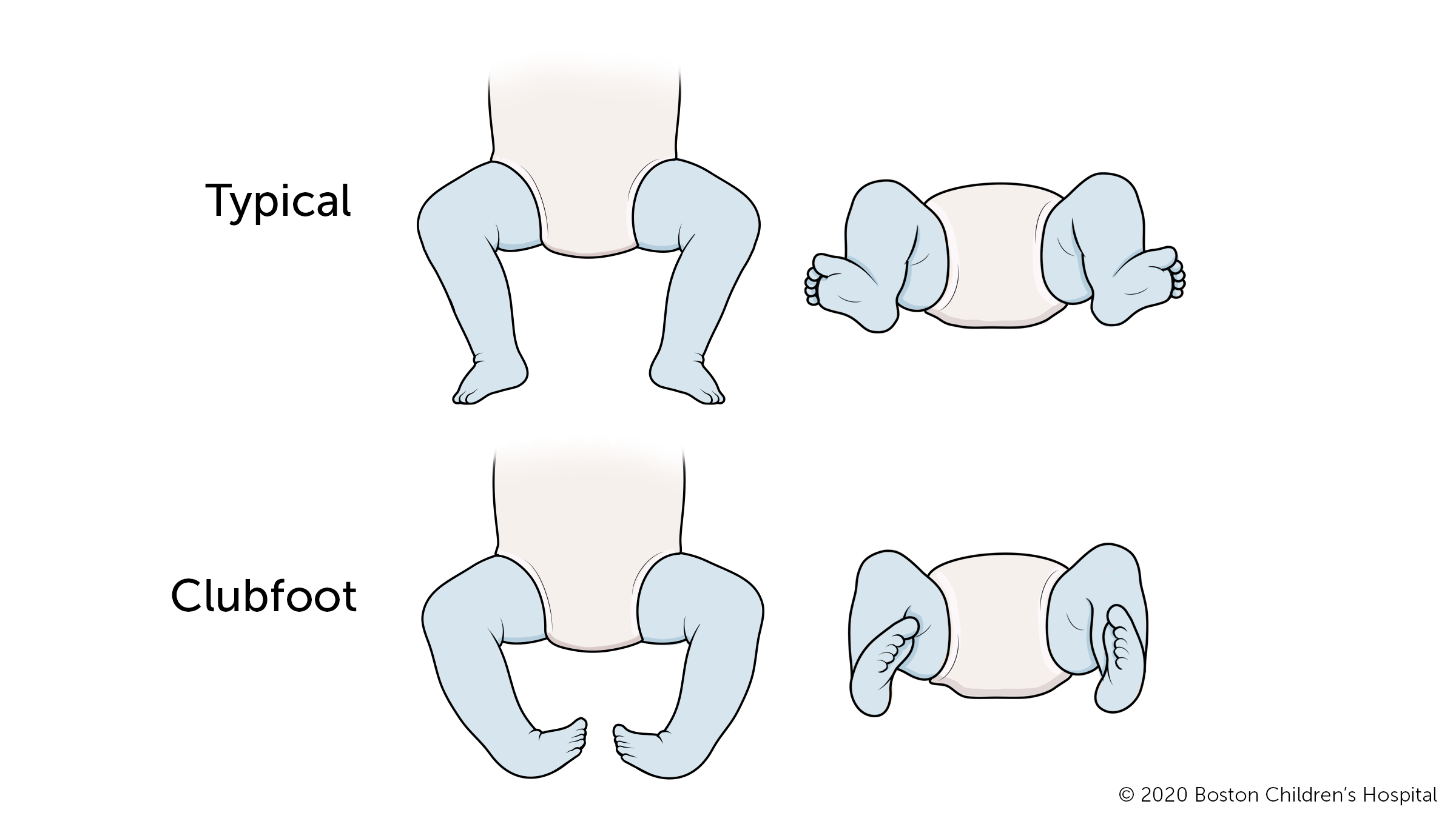 畸形足是指受影响的脚的前半部分向内转动，脚后跟向下。