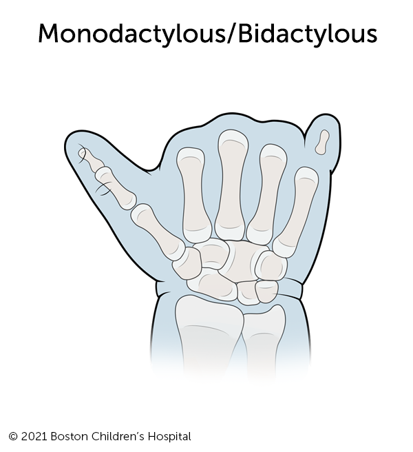 的形象monodactylous / bidactylous symbrachydactyly