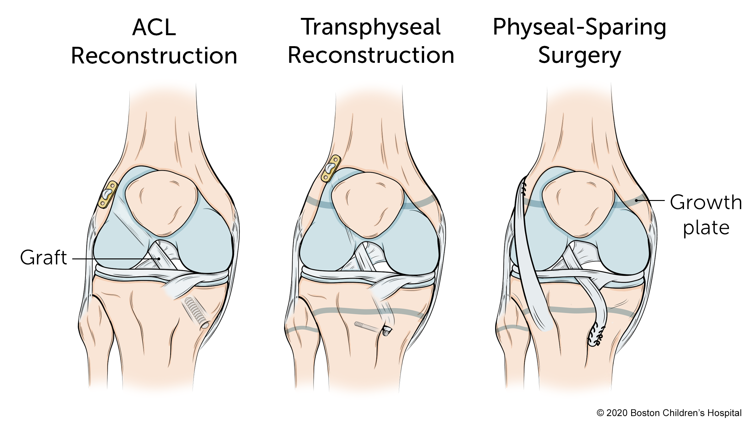 有三种手术类型:前交叉韧带重建、椎间关节重建和保留骨的手术。